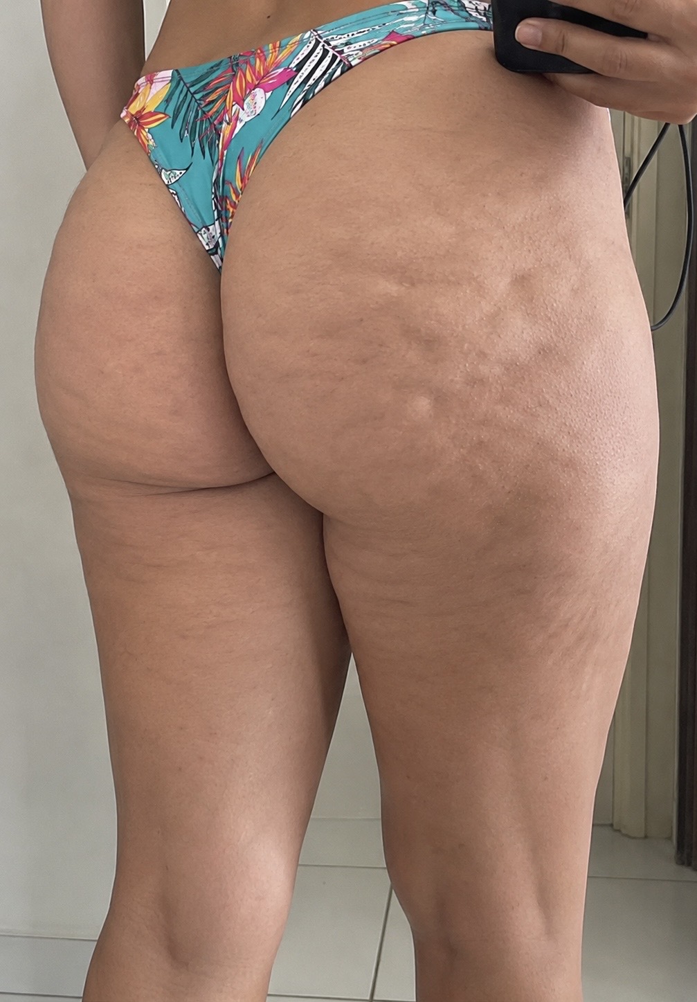 Resultado Bumma Gel em 28 dias antes
